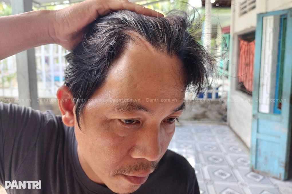 Vợ mất, chồng chấn thương sọ não, 2 con thơ lo thiếu ăn, thất học - 2 Vợ mất, chồng chấn thương sọ não, 2 con thơ lo thiếu ăn, thất học - 2