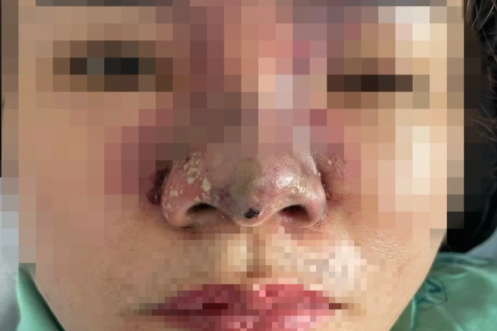 Tiêm filler có thể gây mù vĩnh viễn, bác sĩ nêu nguyên nhân phổ biến - 2