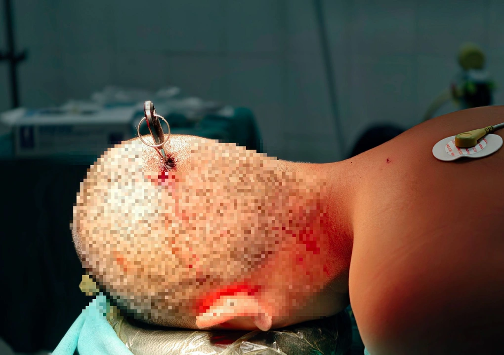 Nam sinh 12 tuổi cấp cứu vì trò đùa dại của bạn, để bút bi dưới ghế ngồi - 2 Nam sinh 12 tuổi cấp cứu vì trò đùa dại của bạn, để bút bi dưới ghế ngồi - 2