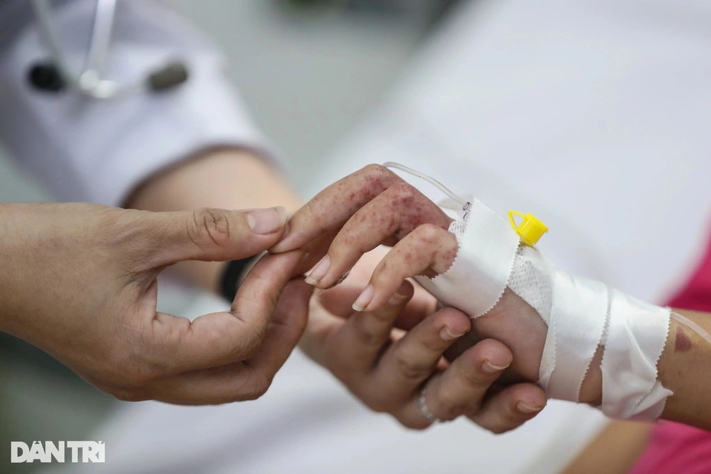 Sốt xuất huyết tăng mạnh, chuyên gia chỉ nhiều hiểu lầm phổ biến - 2 Sốt xuất huyết tăng mạnh, chuyên gia chỉ nhiều hiểu lầm phổ biến - 2