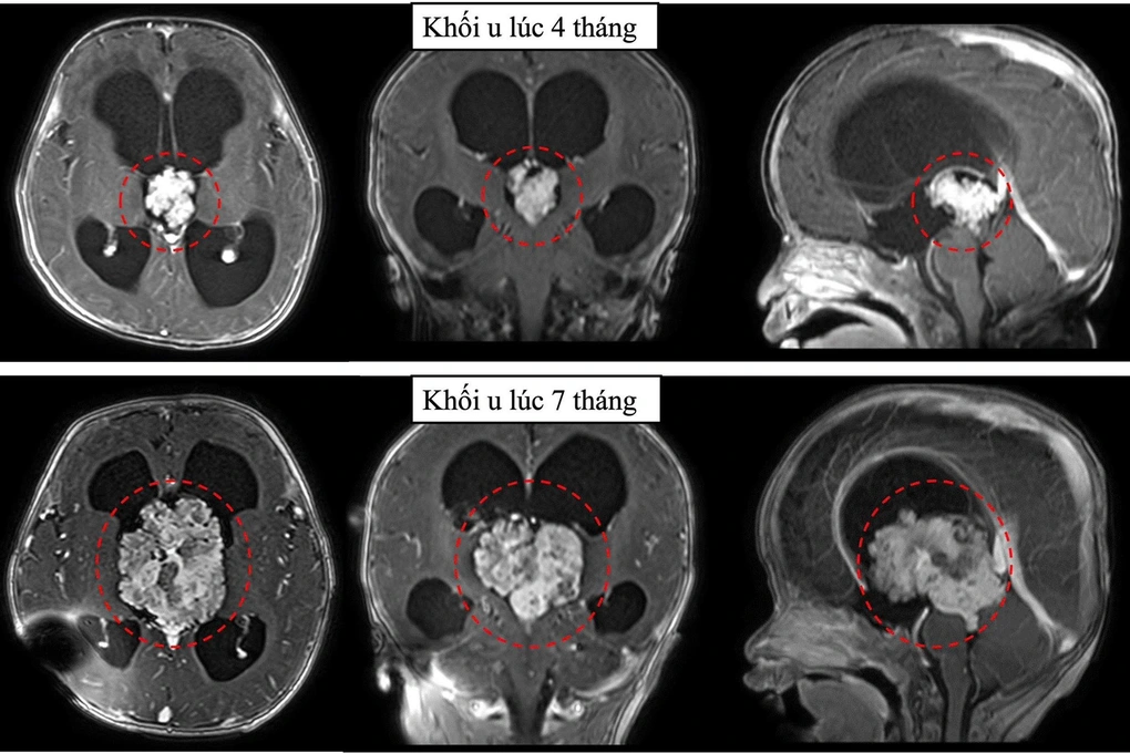 TPHCM: Cấp cứu cháu bé có khối u não to gấp ba lần chỉ trong 3 tháng - 2 TPHCM: Cấp cứu cháu bé có khối u não to gấp ba lần chỉ trong 3 tháng - 2