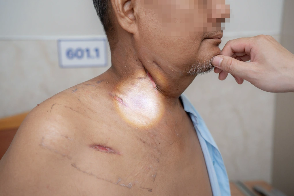 Người đàn ông nhiễm vi khuẩn đa kháng thuốc nguy kịch từ 2 chiếc răng sâu - 2