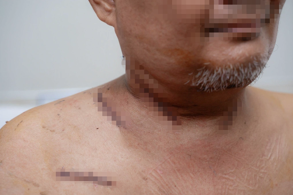 Người đàn ông nhiễm vi khuẩn đa kháng thuốc nguy kịch từ 2 chiếc răng sâu - 3