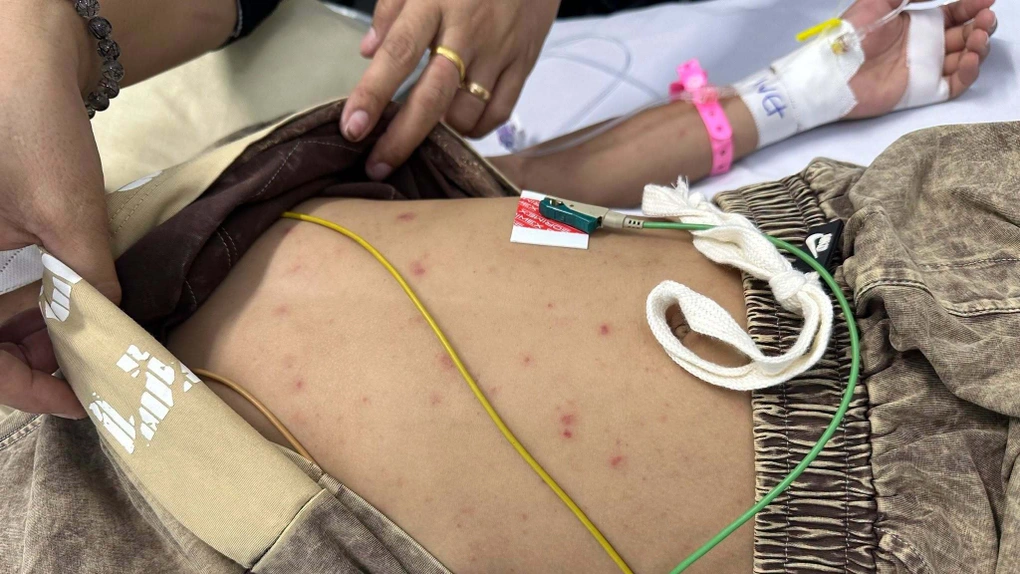 Lá chắn phòng nhóm vi khuẩn não mô cầu trước những thói quen mùa hè - 2 Lá chắn phòng nhóm vi khuẩn não mô cầu trước những thói quen mùa hè - 2